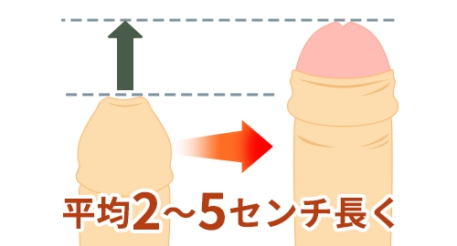平均2～5センチ長くなる長茎術