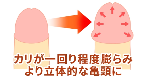 カリが膨らみ立体的な亀頭になれる長茎術