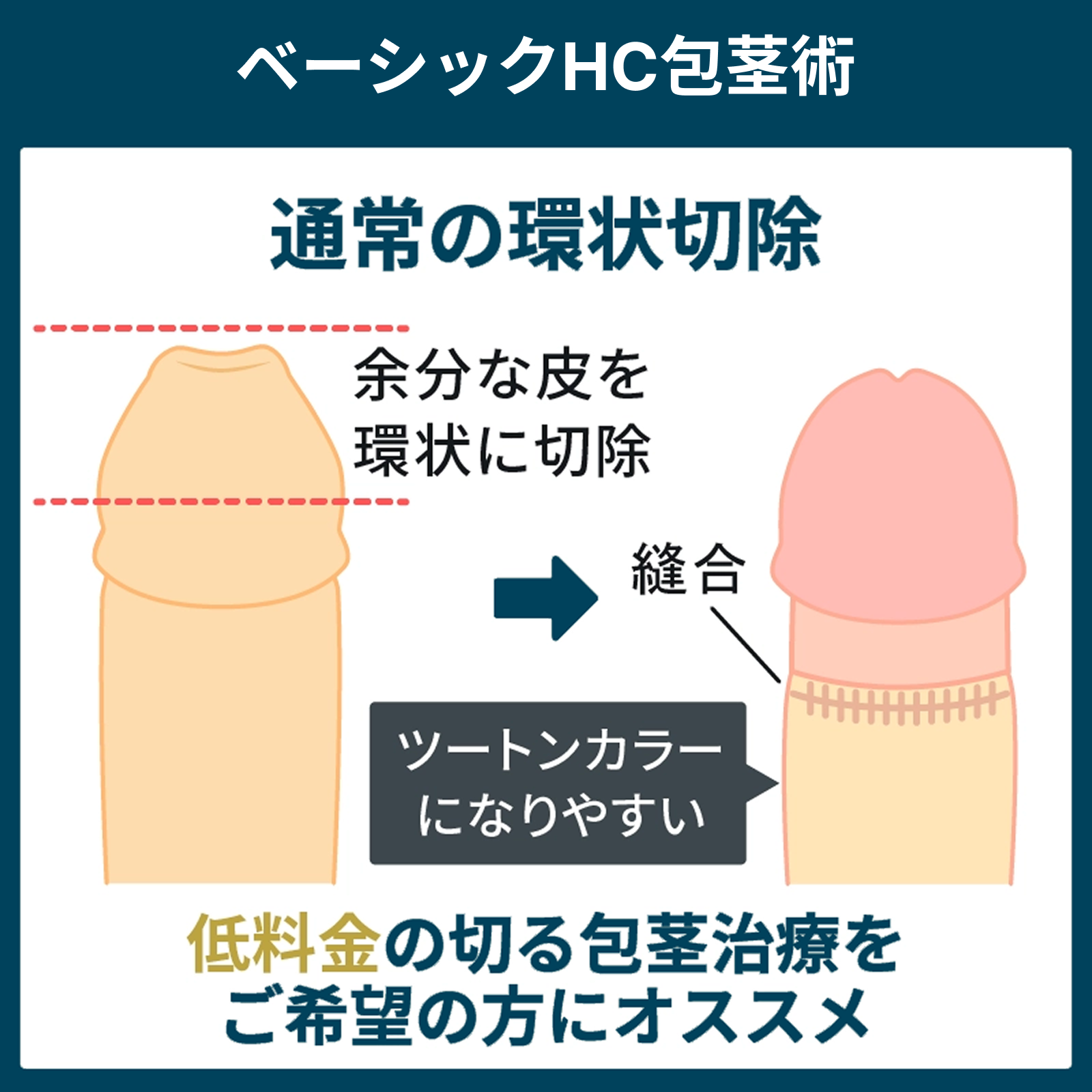 ベーシック包茎術