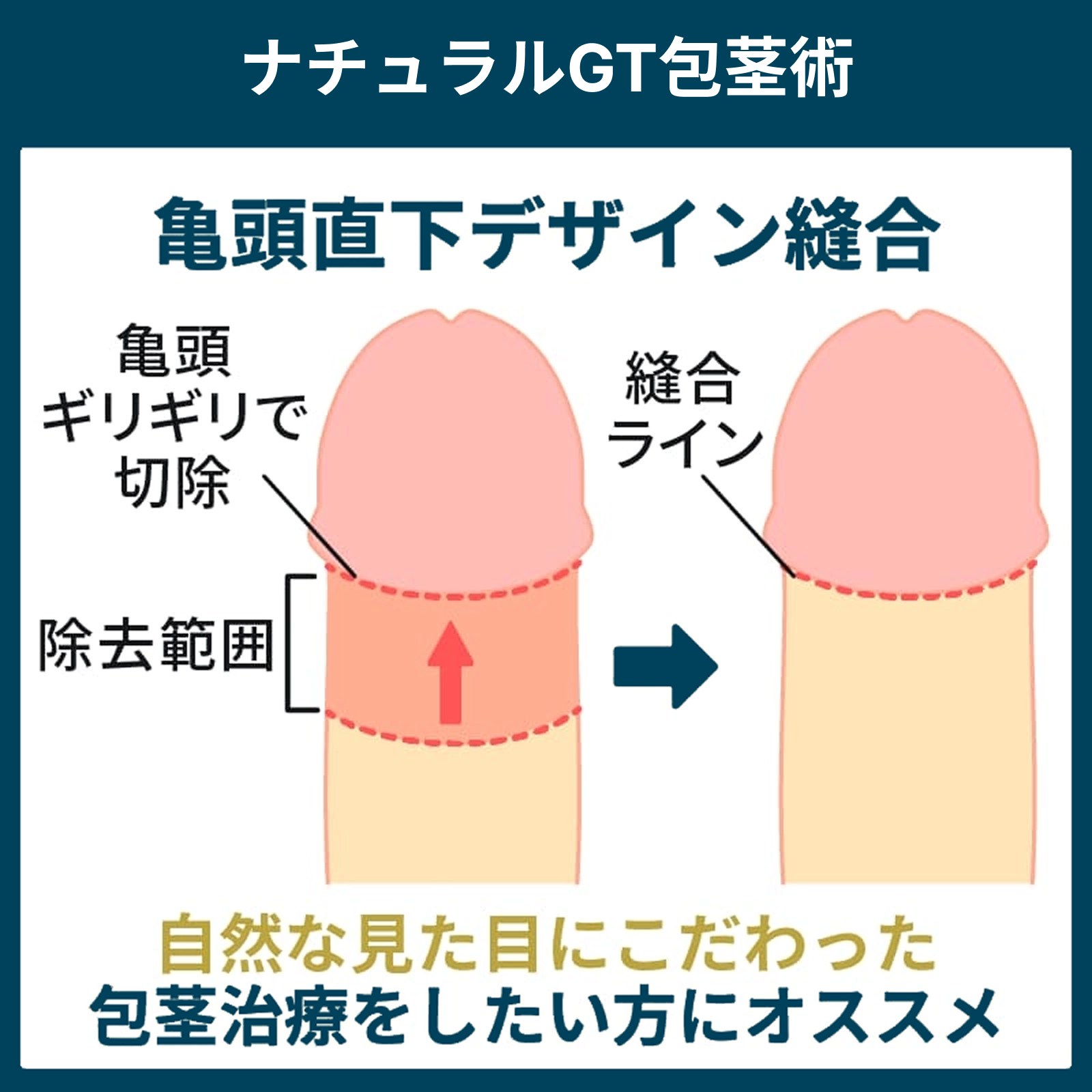 通常時自然な見た目になるナチュラルGT包茎術