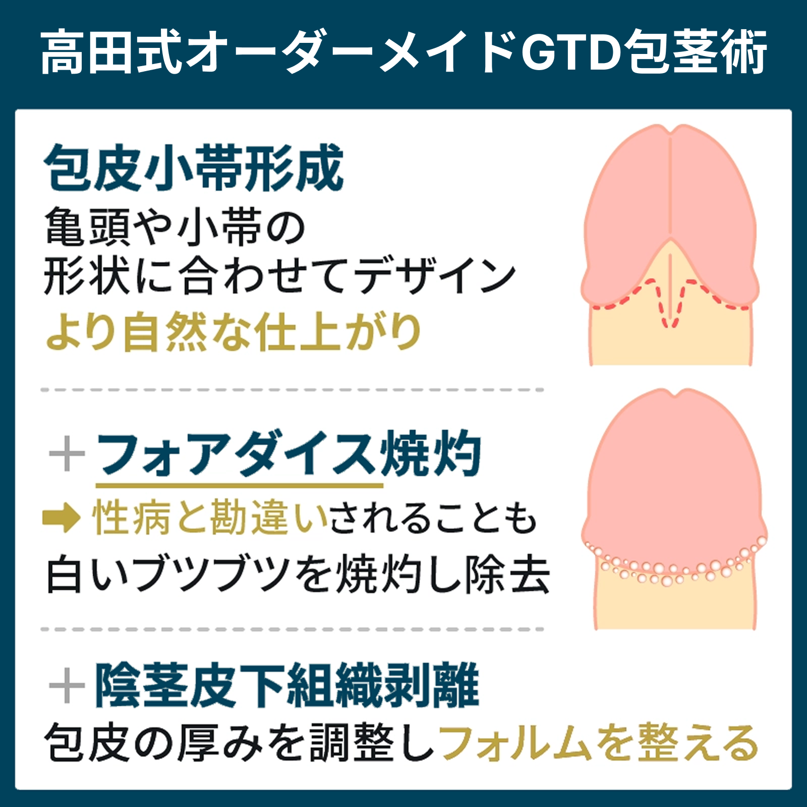 高田式オーダーメイドGTD包茎術